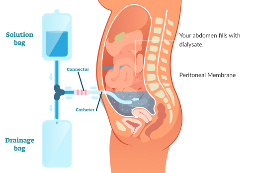 What Is Peritoneal Dialysis The National Kidney Foundation Nkf Singapore